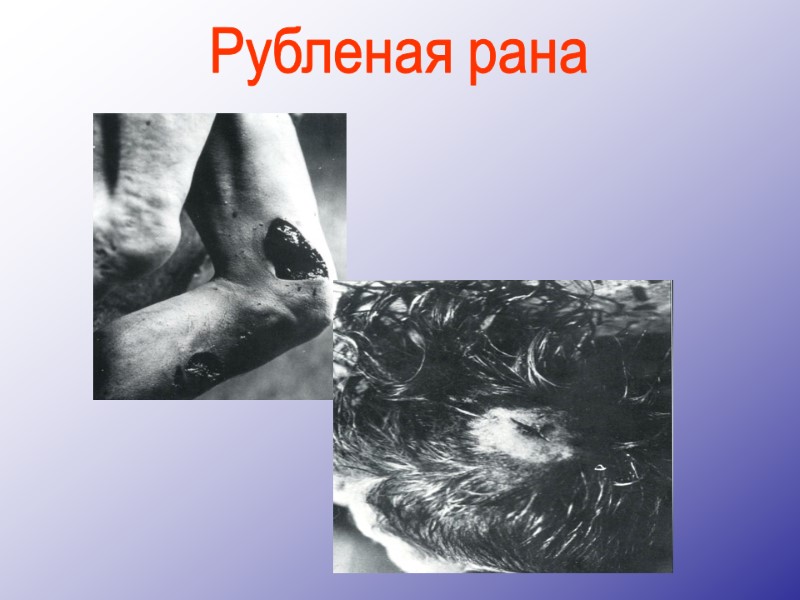 Рубленая рана